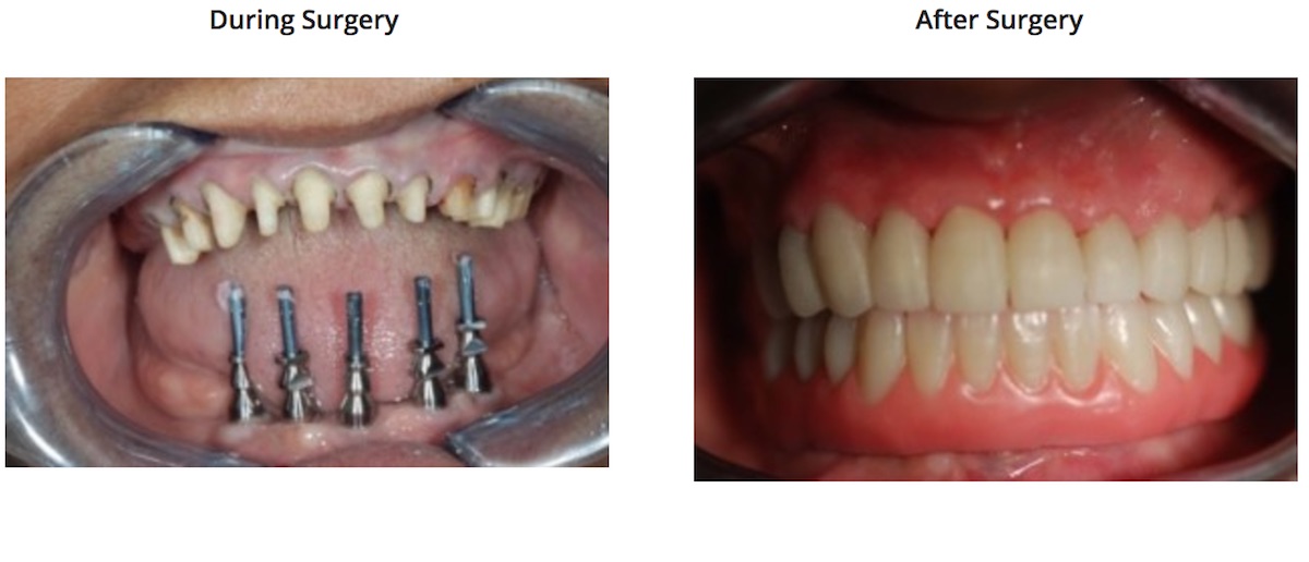 Full Mouth Makeover 65