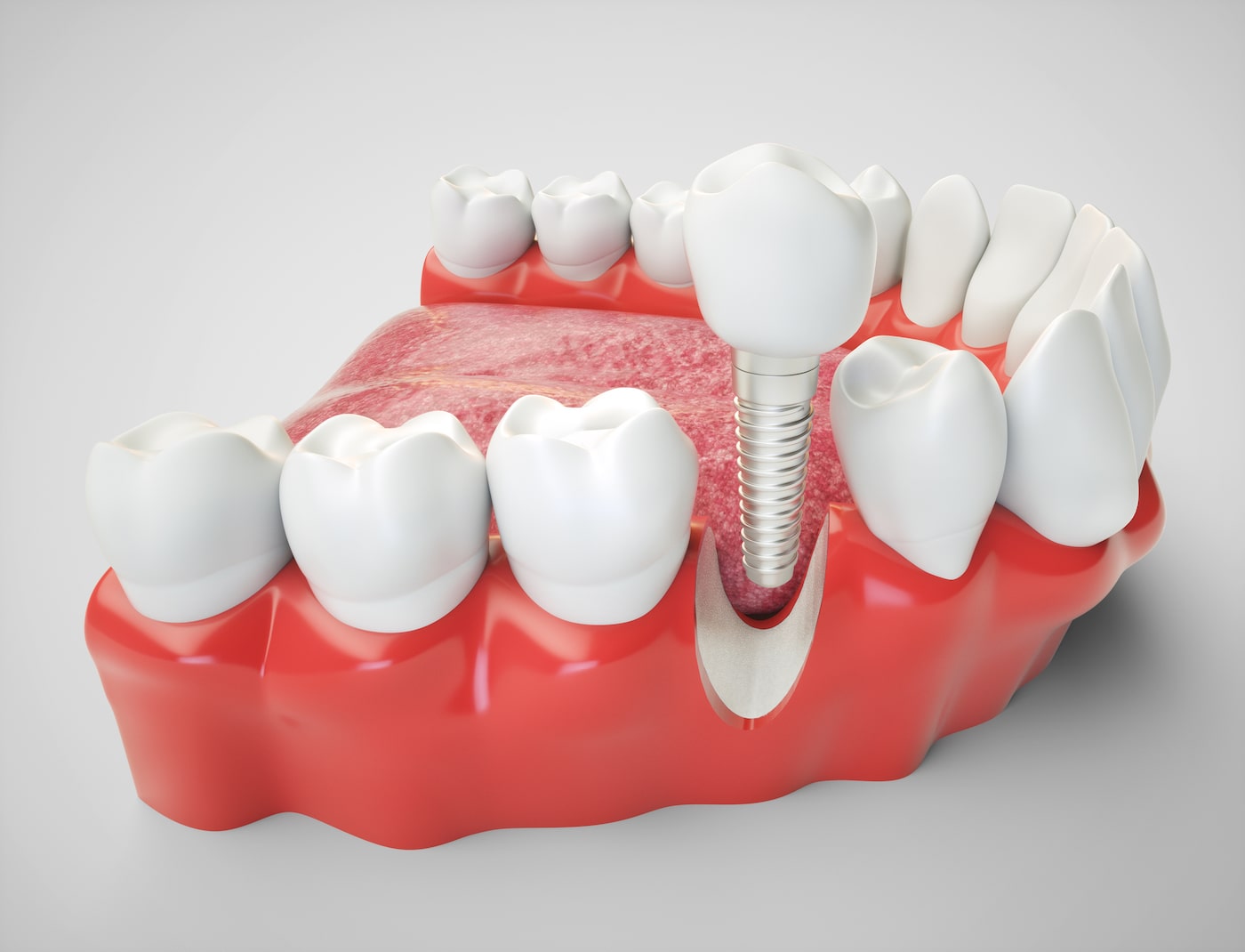 Missing tooth – Dental Implant!