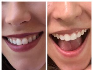 before and after teeth bonding