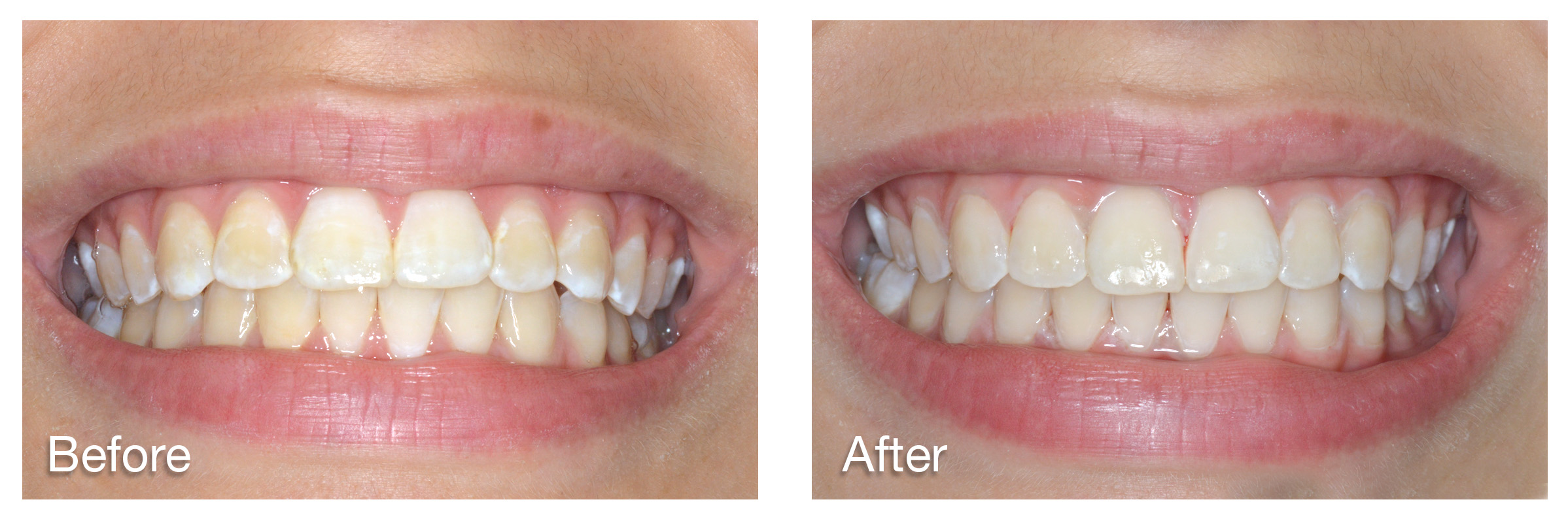 Chicago Style Smiles, Dr. Fisher, bonding, dental, cosmetic dentistry, space between teeth, painless, white spots