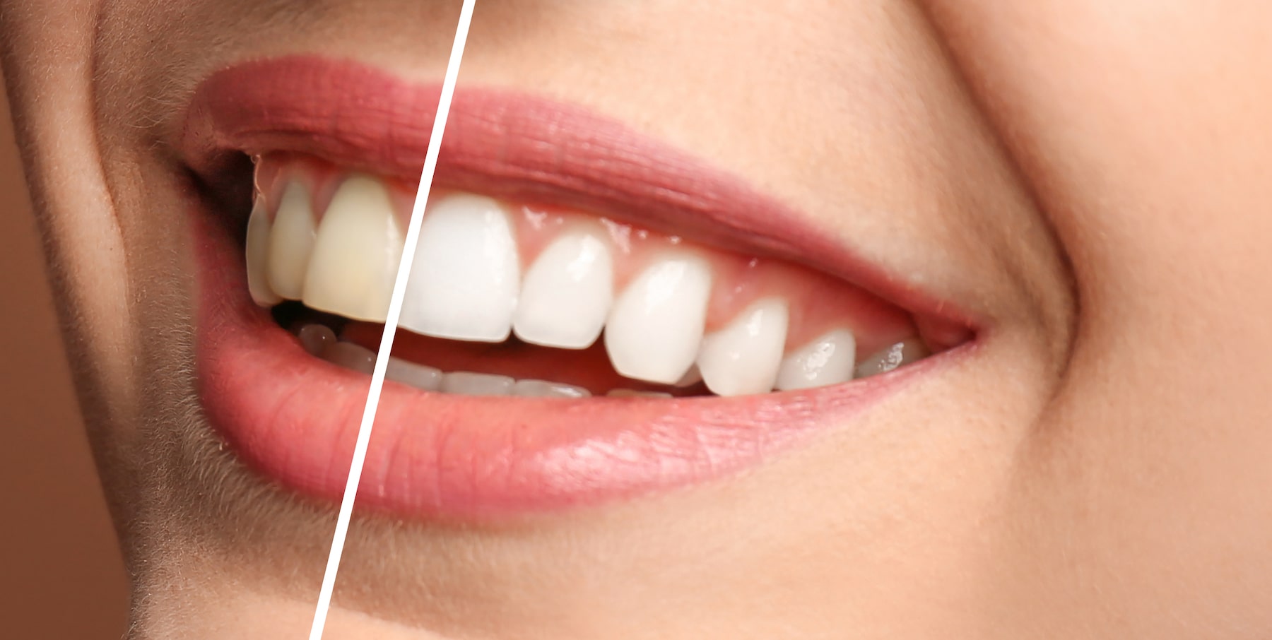 Uncover Your Brightest Smile: Teeth Whitening Services