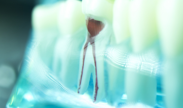 Root Canal Chicago